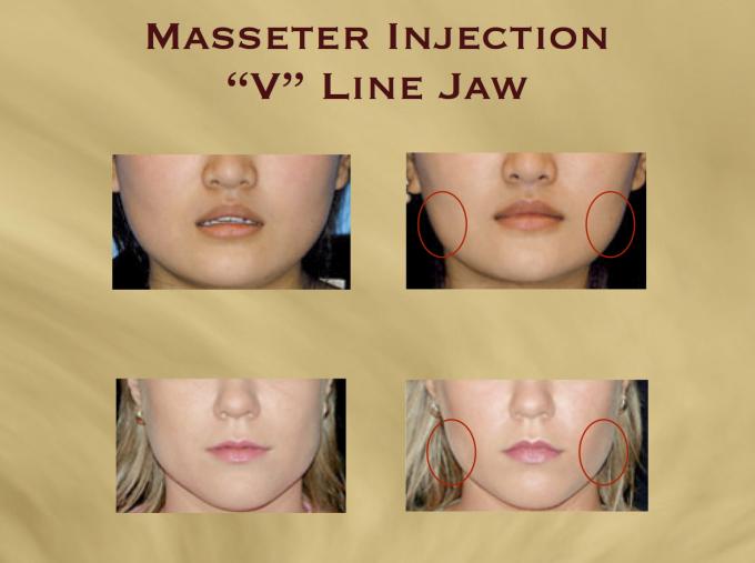 V-Line Masseter Injection with Botox® ("Square Jaw" reduction) - Aesthetics  Hawaii