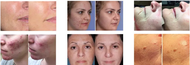 LED Facial Light Infrarosso LED Terapia PDT LED Professionale Macchina Bio Fotomodulazione LED Light Fototerapia 4
