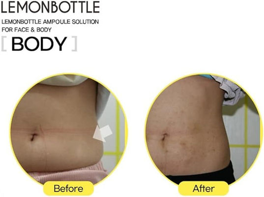 Bottiglia di limone 10ml*5 Soluzione del grasso in eccesso e perdita di peso Lipolab Kabelline